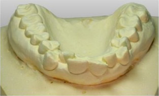 マウスピース症例模型 前