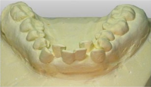 マウスピース症例模型 前