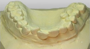 マウスピース症例模型 前