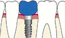 インプラント
